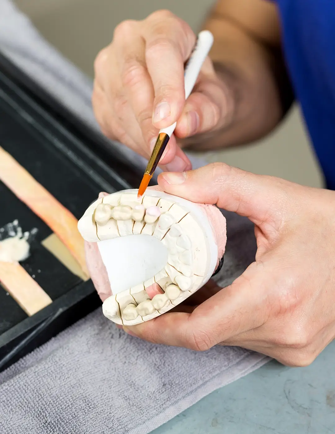 Dental inlays and onlays for tooth restoration