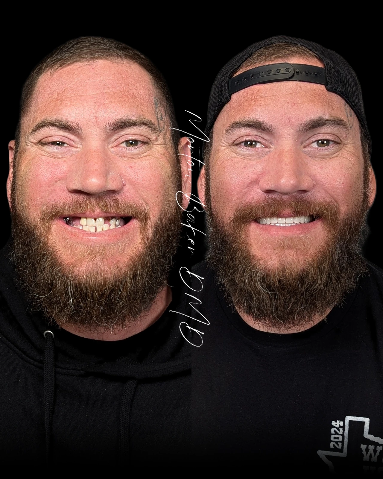 A real Dr. Baker patient before and after new dentures