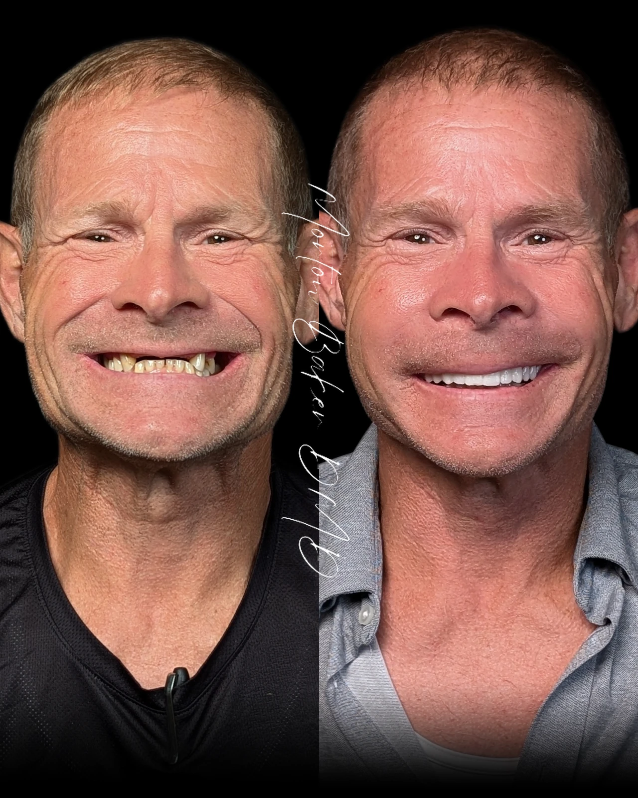 A real Dr. Baker patient before and after his new smile