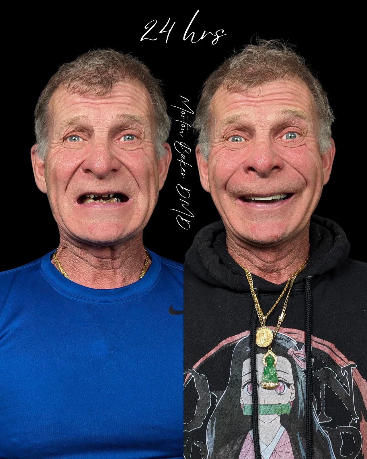 All-on-X before and after
