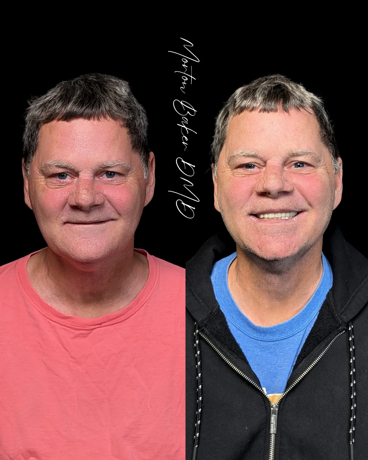 Bill's denture results