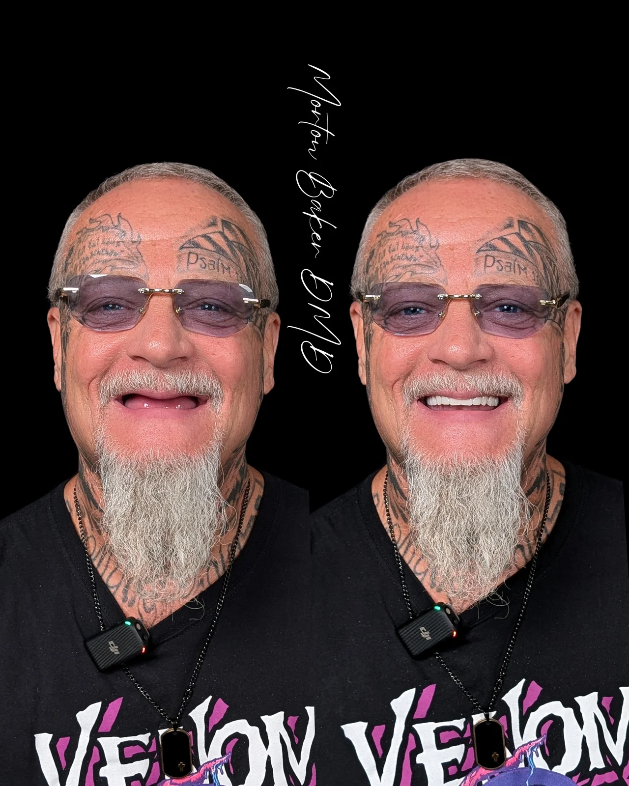 A real patient before and after snap-in denture teeth