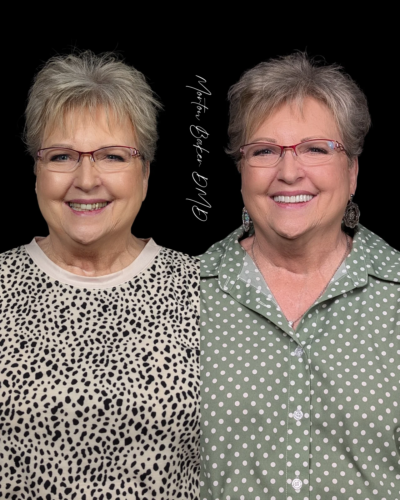 A real Dr. Baker patient shown before and after her new smile