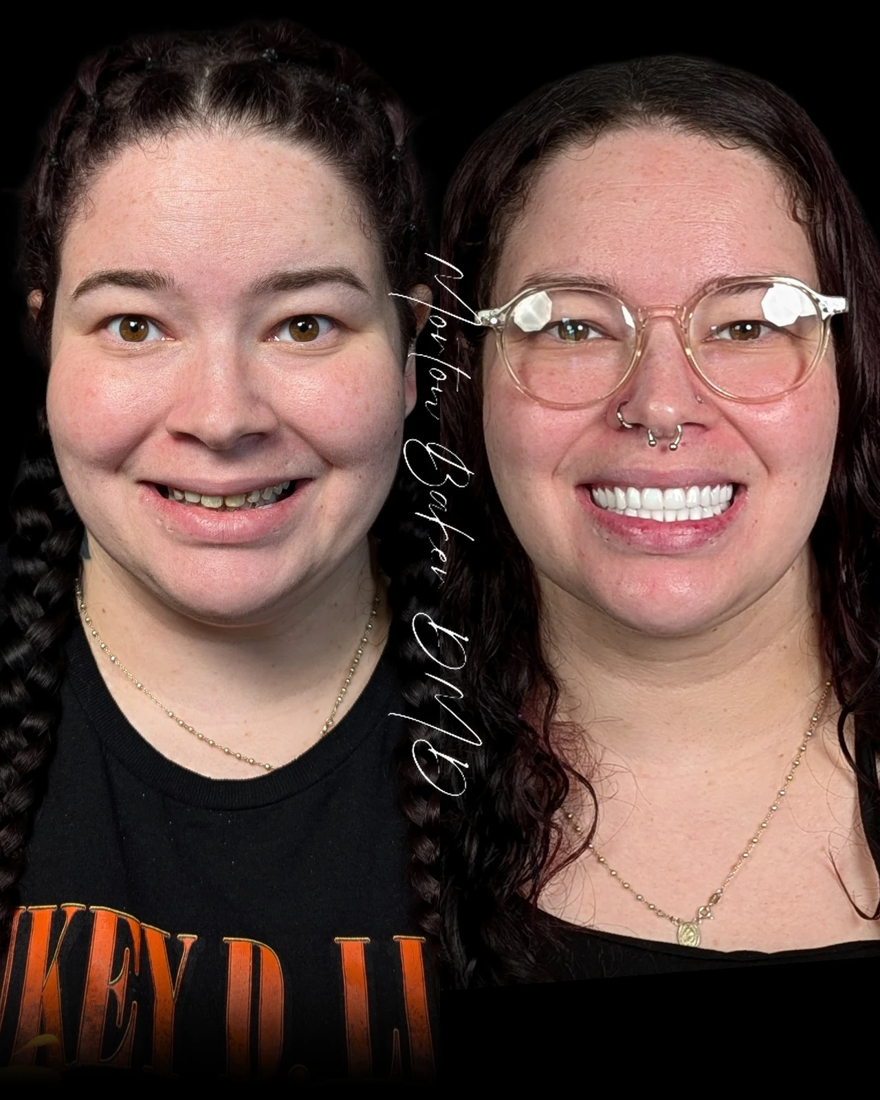 A real patient before and after snap-in denture teeth