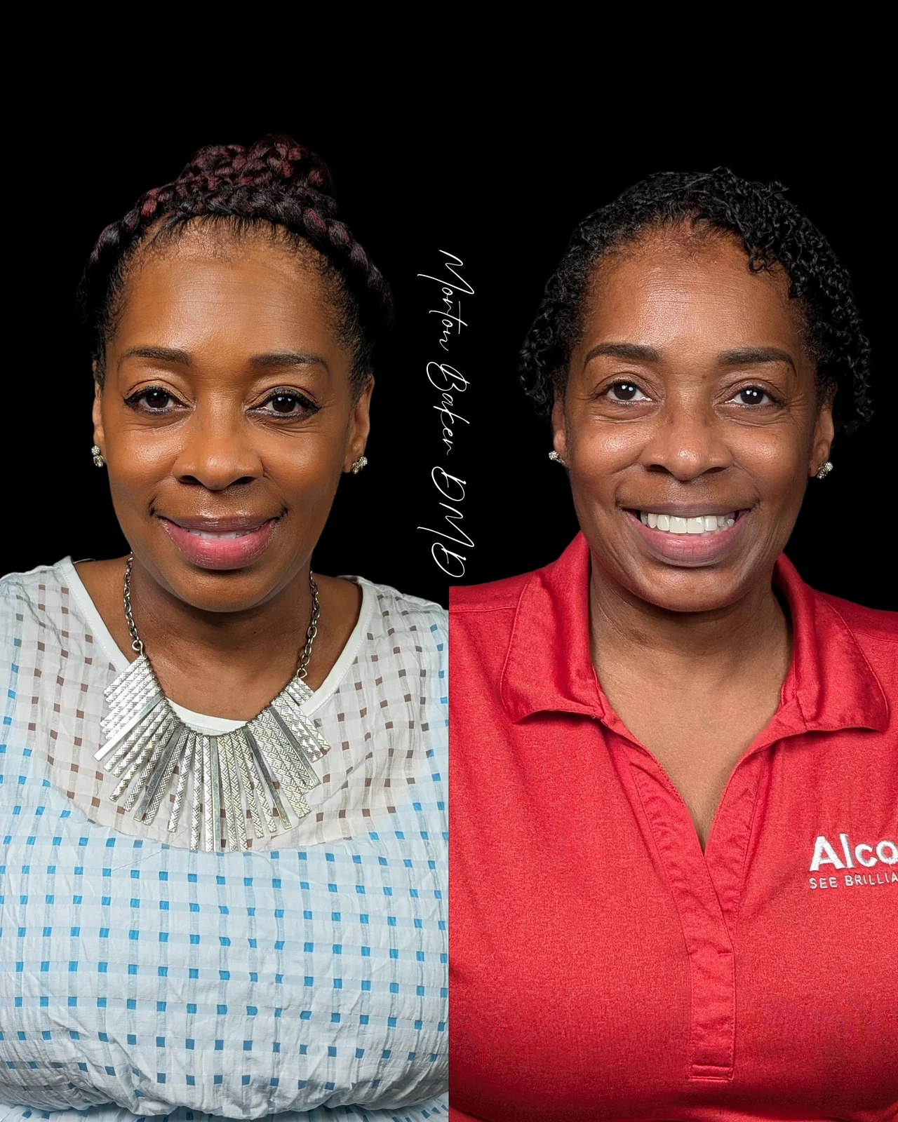 A real Dr. Baker patient before and after her new smile