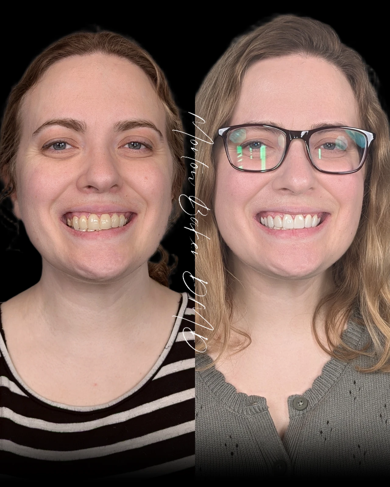 A real patient before and after a smile makeover