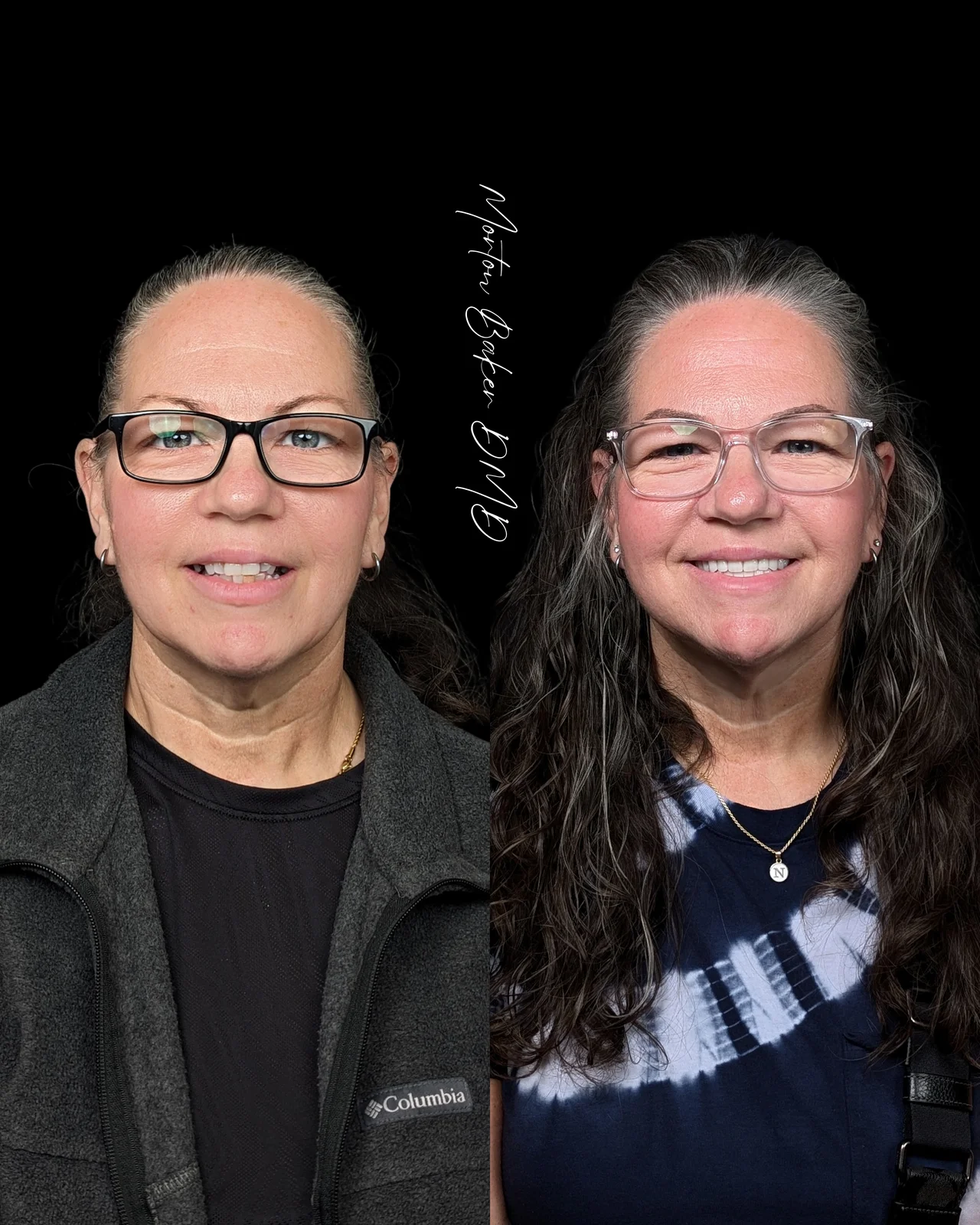 A real Dr. Baker patient before and after her new smile