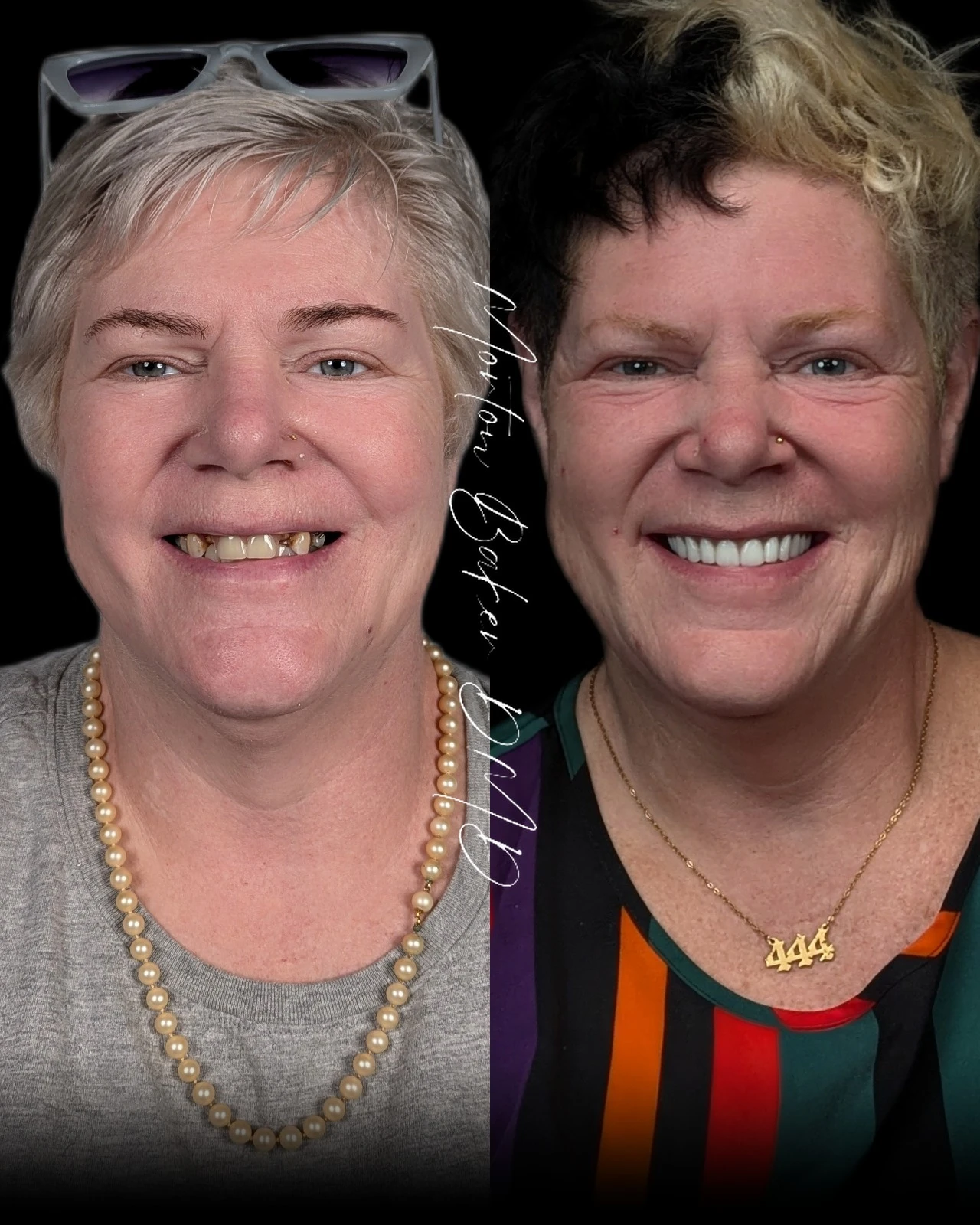 A real patient before and after snap-in denture teeth