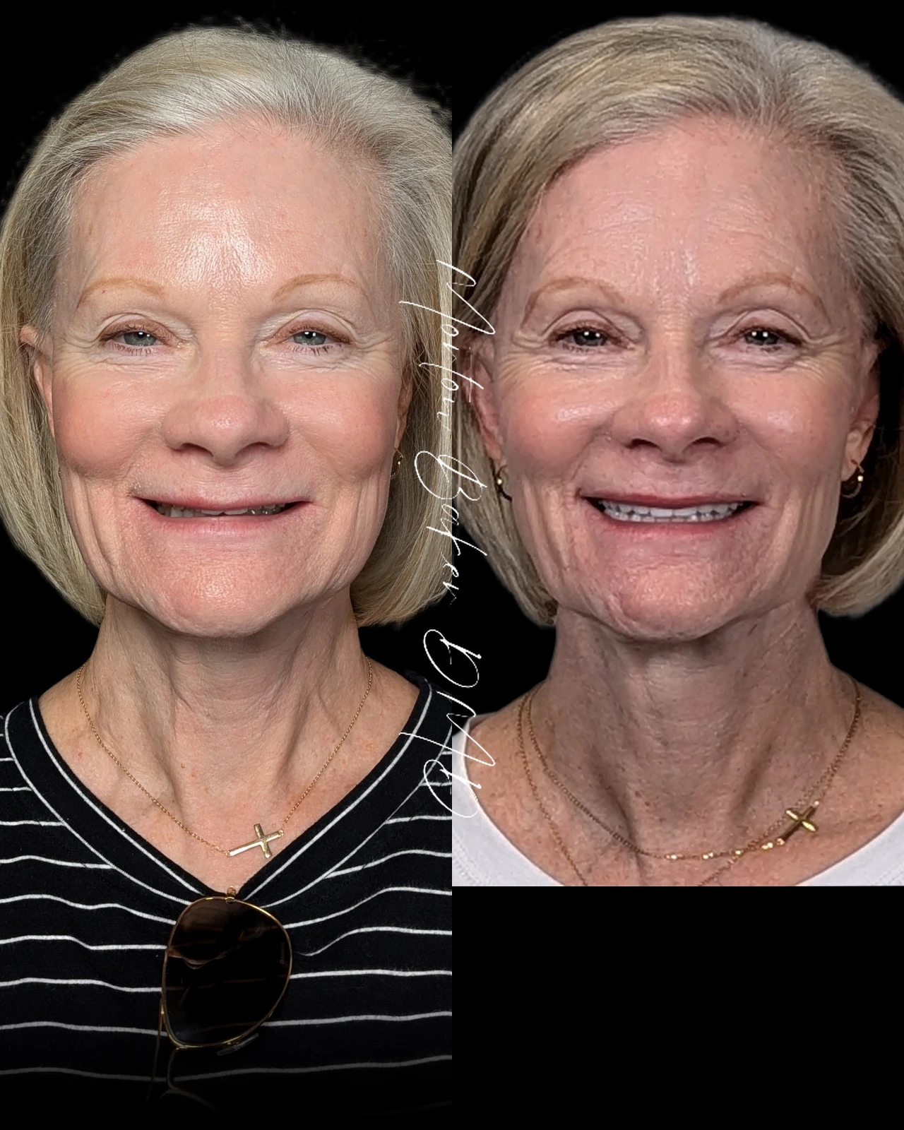 A real patient before and after a smile makeover